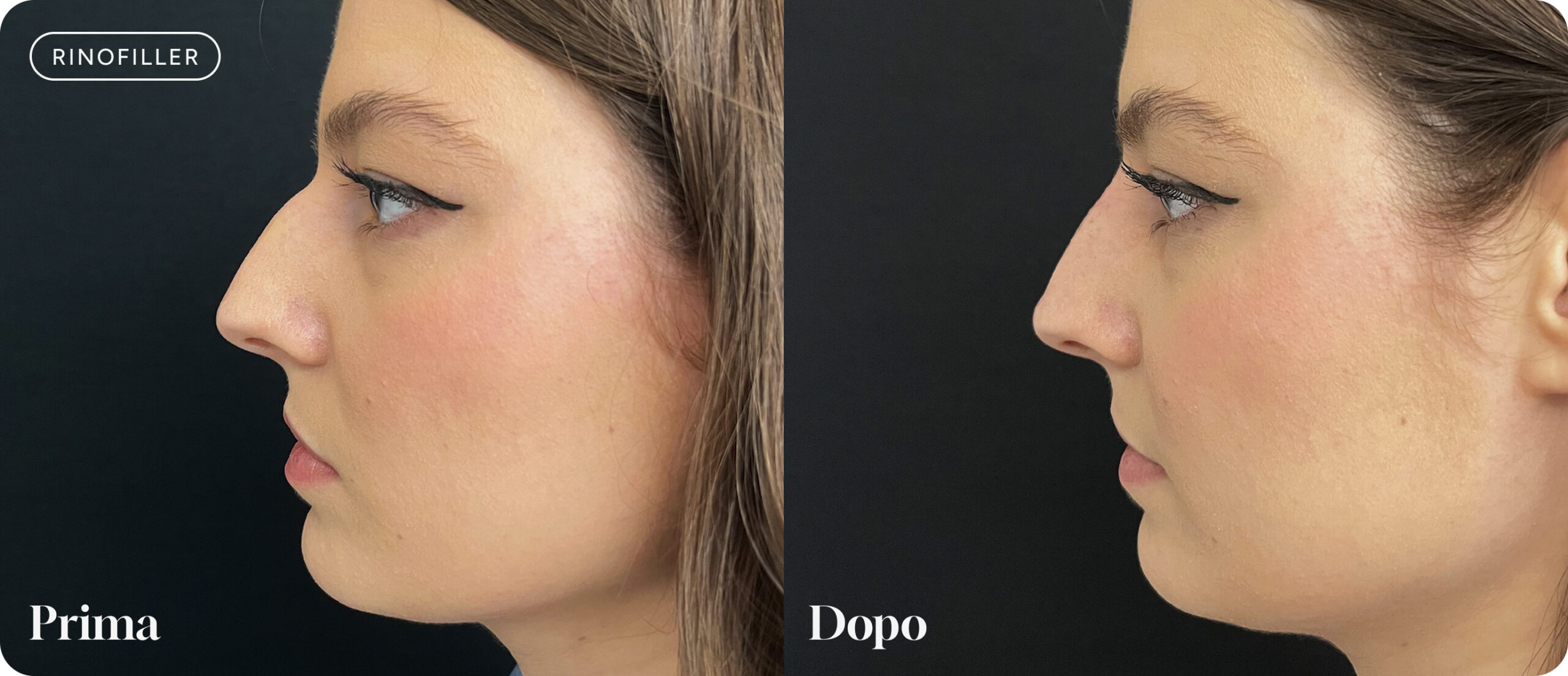 rinofiller-prima-dopo