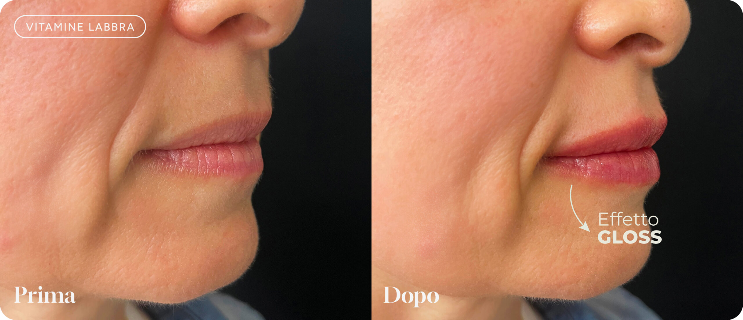 prima-dopo-vitamine-labbra